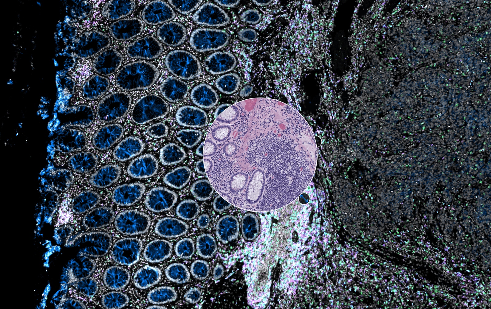 Nueva herramienta para diagnóstico y estudo de cáncer